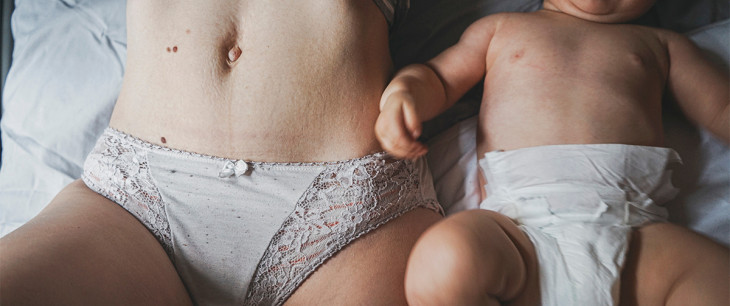 Ako sa zbaviť strií po pôrode?