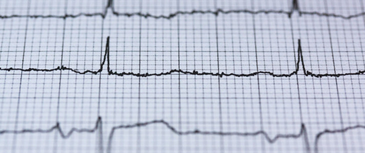 Srdce, ischemická choroba a fyzioterapia po infarkte myokardu