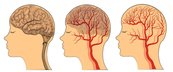 Zúženie ciev v mozgu: Príznaky, dôsledky a prevencia