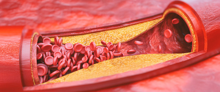 Ateroskleróza: Príznaky, diagnostika, liečba a prevencia