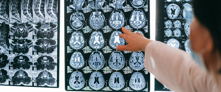 Mozog pred a po ischemickej cievnej mozgovej príhode (1.časť)