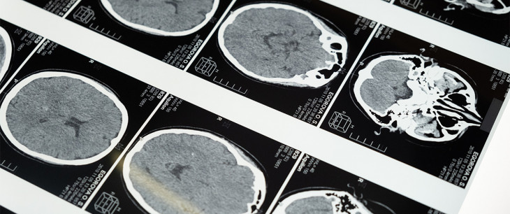 Mozog pred a po hemoragickej cievnej mozgovej príhode (2.časť)