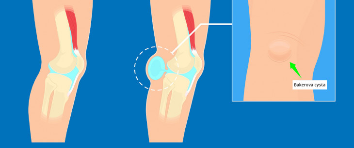 Bakerova cysta: Diagnostika a liečba cysty pod kolenom
