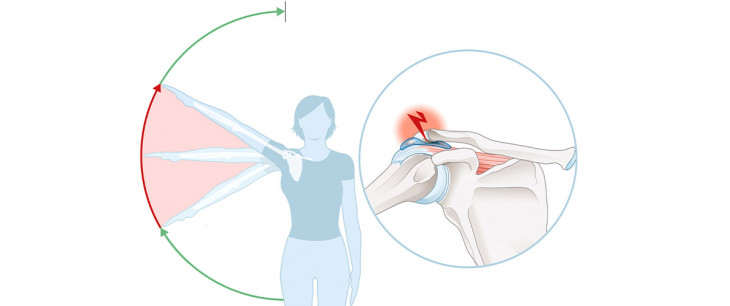 Tendinosis calcarea: Kalcifikácia šliach