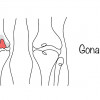 Gonartróza: Ako pri nej riešiť bolesti kolena? · PROFY