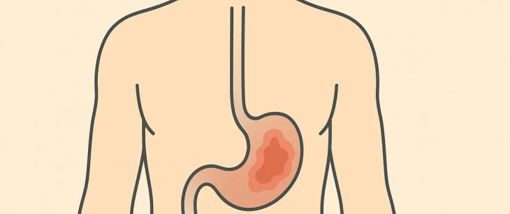 Gastritída: Kompletný prehľad o ochorení, druhoch, príčinách, symptómoch a liečbe